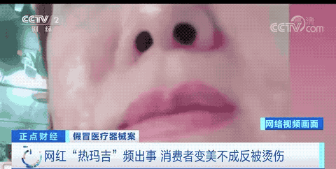 天游平台注册地址央视曝光：女子花1万元做热玛吉，变美不成反被烫出“一脸泡”